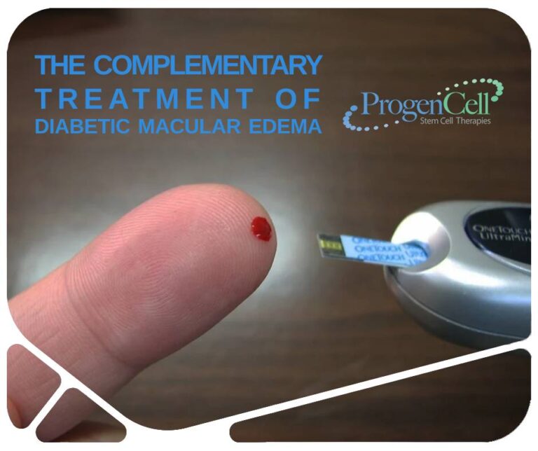 Stem cells The Complementary Treatment of Diabetic Macular Edema
