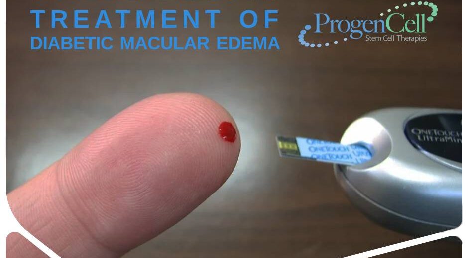 Treatment of Diabetic Macular Edema