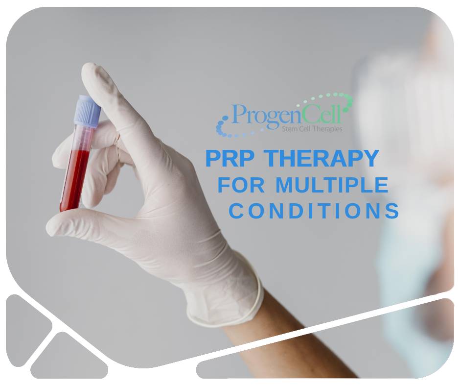 PRP therapy