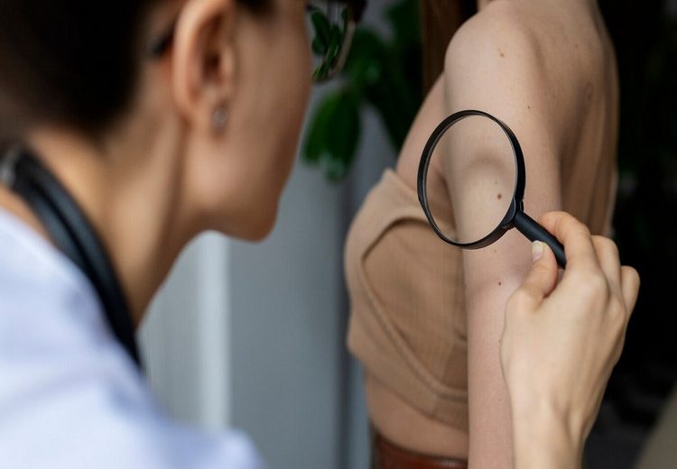 How to Treat Scleroderma